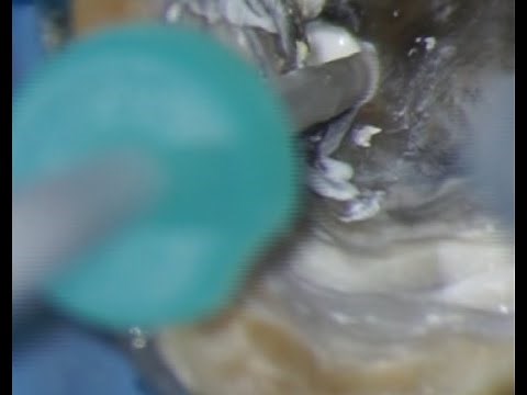 Bioceramic sealers-obturation techniques & latest updates