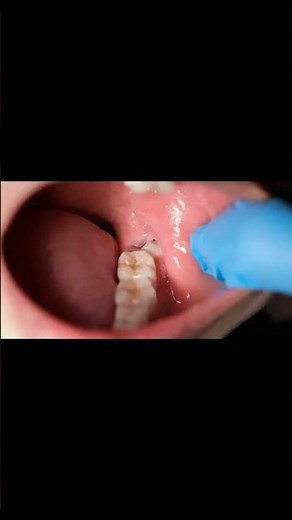 CIRUGÍA DE CORDALES O MUELAS DEL JUICIO 🦷
