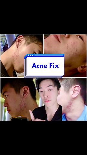 How to Clear Acne Around Jawline: Tips & Solutions