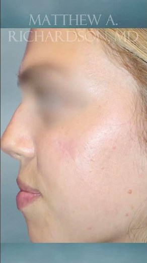 Cyst Removal Transformation!