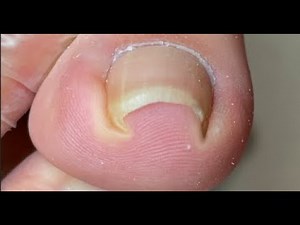 Curved nail "Bites" the Toe