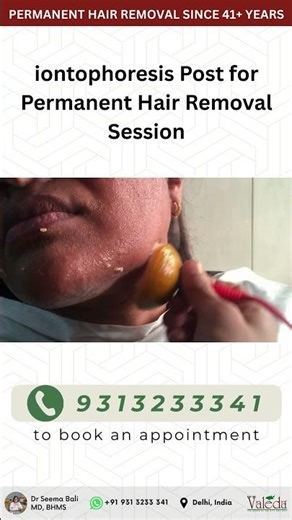 Iontophoresis After EBVHCM | Post Care for Permanent Hair Removal | Valeda