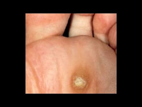 Apple Cider Vinegar Wart Treatment @ HOME!