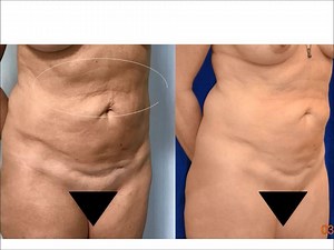 J PLASMA body and skin reconditioning of abdomen, back, flanks and waist regions