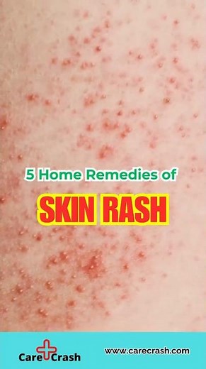 5 Effective Home Remedies for Skin Rash | #carecrash