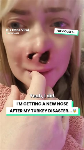 Turkey teeth destroyed my nose