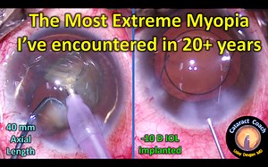 The Most Extreme Myopia that I’ve seen in 20  years