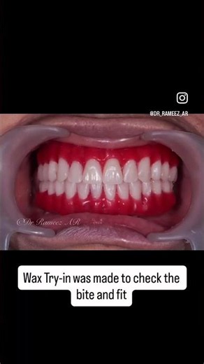 Watch This Full Mouth Implant Transformation!❤️