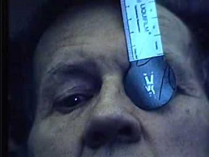 Abnormal Cranial Nerve Exam : Cranial Nerves 3, 4 & 6- Ductions