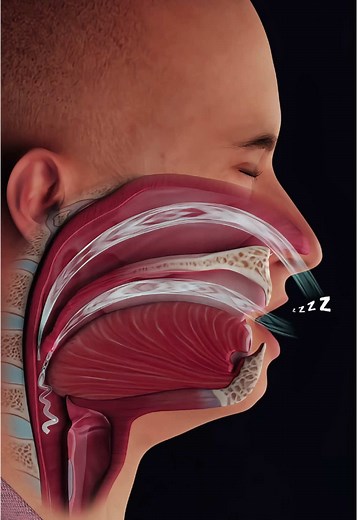 Understanding Snoring: Causes and Solutions