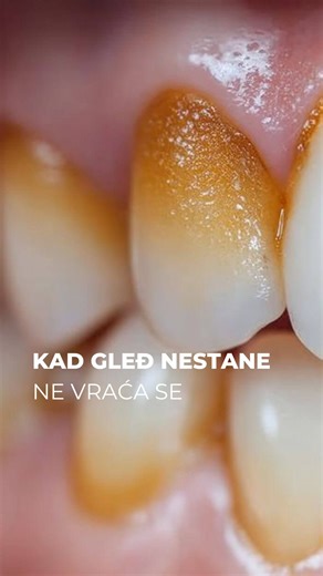 JK Dental Clinic on Instagram: "Kiseline iz gaziranih pića postepeno razgrađuju zaštitni sloj zuba – gleđ. Taj proces se zove erozija zuba. Prvi znaci mogu biti: • sitne rupice na površini zuba • osetljivost na toplo i hladno • istanjene i providne ivice zuba • promena boje i gubitak sjaja ⚠️ Važno je znati: jednom istrošena gleđ se ne može prirodno obnoviti. Ako primećujete bilo kakvu promenu na zubima ili osmehu – 📸 pošaljite nam fotografiju i proverićemo da li je u pitanju erozija zuba. Rano