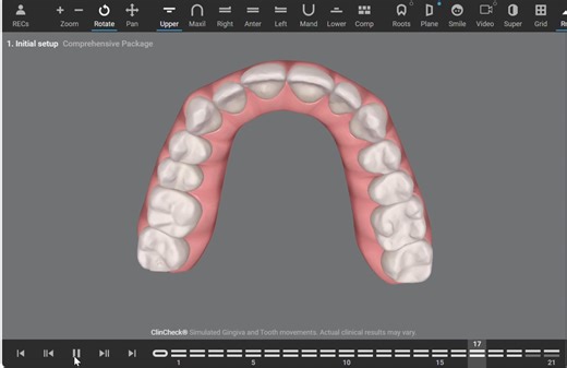 Invisalign ClinCheck is a 3D Virtual Treatment Plan used to generate a simulation that shows how your smile will transform over time. Each incremental movement corresponds to one clear aligner. In this case, there were 21 aligners. Typically, our doctors recommend wearing an aligner for 2 weeks before switching to the next one, so this case would require around 10 months to complete the treatment. Thanks to the ClinCheck video you can see your future smile before starting orthodontic treatment. 