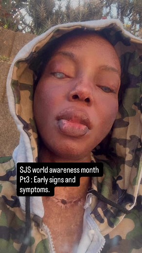 Steven Johnson Awareness Month: Early Signs & Symptoms