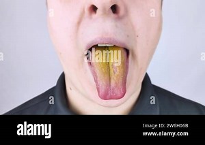 The man has a yellow tongue. Painful yellow coating on the mucous membrane of the tongue. Diseases of the gastrointestinal tract, liver and gallbladder. The consequences of taking antibiotics Stock Video Footage - Alamy