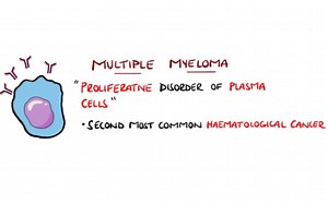 多发性骨髓瘤(Multiple Myeloma ）