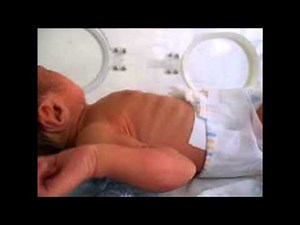 BPD-Bronchopulmonary Dysplasia