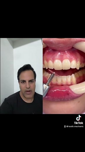 cosmetic tooth contouring and reshaping#dentist #Tooth #Makeover