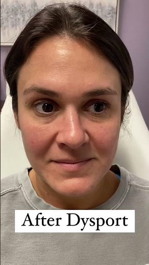 Before and After Dysport Treatment