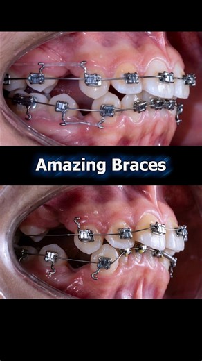 The incredible transformation of protruding teeth through braces #braces #dentist #orthodontics