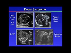 Fetal Congenital anomalies part2