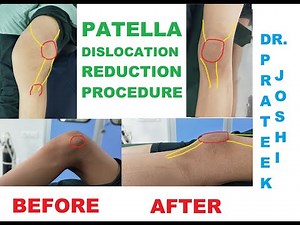 PATELLA DISLOCATION REDUCTION PROCEDURE | DR. PRATEEK JOSHI
