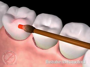 LANAP El tratamiento de la enfermedad de las encías, mínimamente invasivo