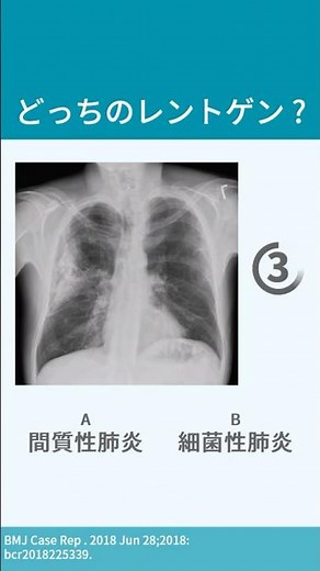 【10秒で解説】肺炎でのレントゲン