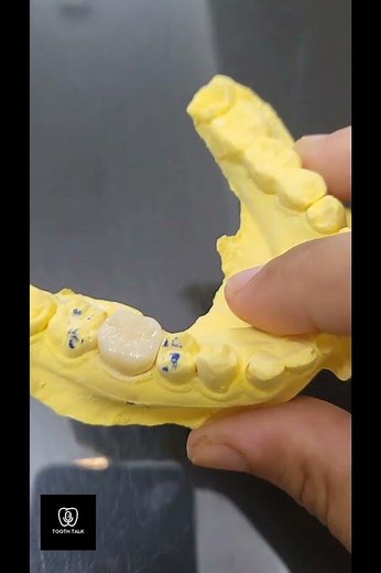 Zirconia Crown Before & After | Crown Cutting + Cementation on Patient Cast 🦷 #DentalShorts"