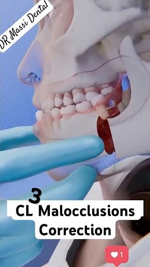 CL 3 Malocclusions surgery procedure demo
