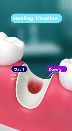 🦷 Tooth Extraction Timeline: How Healing Usually Happens