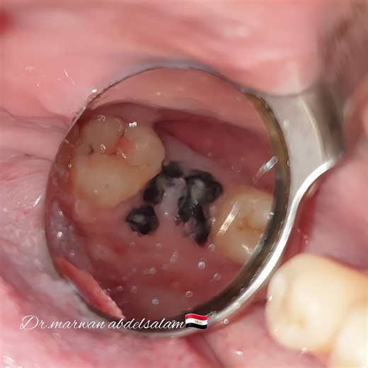 Marwan Mohamed Abd AlSalam | -Atraumatic extraction for tooth No.26 -Curettage of extraction socket -Socket preservation with xenograft -Hidden X suture... | Instagram