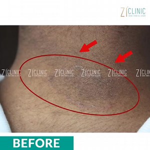 Superficial fungal infection of beard area and neck. Itchy Red scaly ring shaped skin rashes caused mostly occurs in Sweat prone / covered areas . Treatment - ⭕Avoid Sharing unsanitary razors / towels & soap ⭕watch out for a Similar rash in any other family member or in self ⭕Maintain hygiene ⭕Use antifungal soap or shampoo for cleansing as recommended by dermatologist ⭕Oral and topical antifungal treatment for minimum 6-8 weeks time. Do not use over the counter creams for this type of fungal in