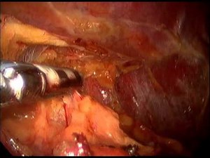 Right Adrenal Gland Adenoma- Laparoscopic Excision • Video • MEDtube.net