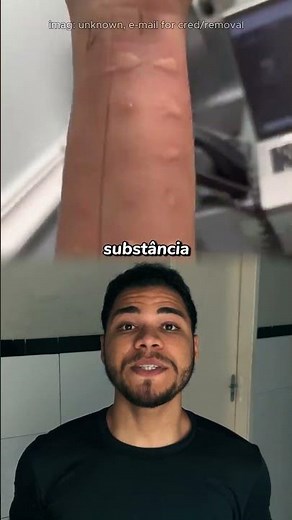 Como funciona um teste cutâneo de alergia