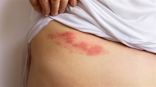 Varicella’s hidden phase inside the body