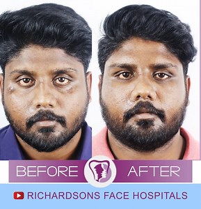 4 Things You Must Know About Facial Scar Revision Surgery In India – Richardson's Plastic Surgery Hospitals