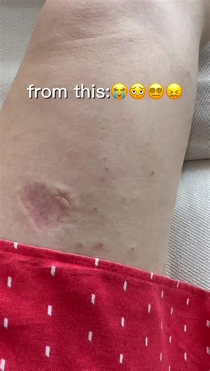 Effective Eczema Relief Techniques You Need to Know