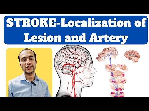 Approach to Stroke/CVA case - Localization of lesion and artery clinically #stroke #neurology