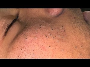 Deep Pore Cleansing/ Blackheads Removal And Skincare Solutions |