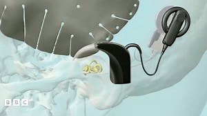 What are cochlear implants and how do they work?