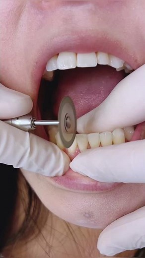 IPR aka Interproximal Reduction with Braces or Invisalign - TheBracesDoc