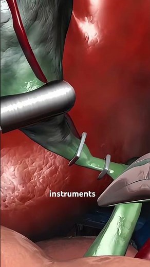 This is what happens during gallbladder surgery (3D Animation)#cholecystectomy #gallbladdersurgery