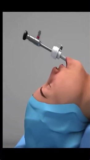 Thyroid stimulating hormone TSH thyroid Gland surgery