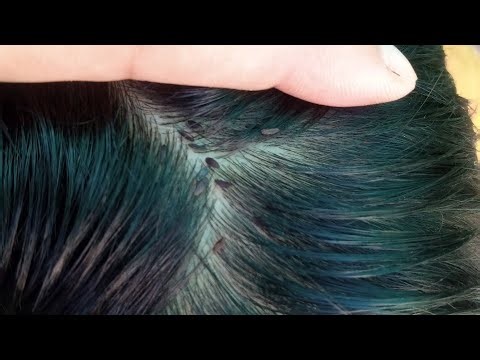 ASMR lices nites mother removed son clean hair 😀