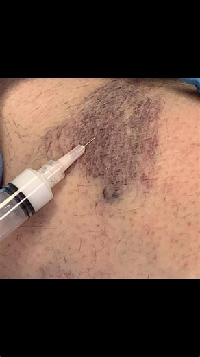 Sclerotherapy for dense patch of blue telangiectasias by @veintreatmentcenter You may need more than one session of therapy. Some individuals need additional cosmetic laser therapy. 1. Sclerotherapy is not an instant fix. 2. It can take 2-3 months or more for the veins to disappear. 3. More than one session may be necessary for a treated or injected area. 4. The injected veins will look worse before they get better. 5. Patients with darker skin pigmentation are at higher risk for permanent skin 