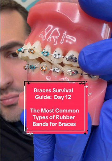 Braces Survival Guide Day 12: Common Rubber Bands for Braces