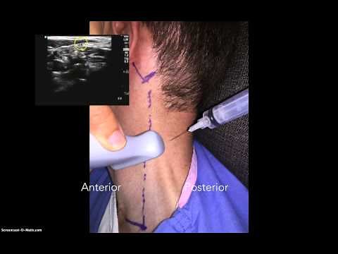 Cevical Plexus Nerve Block
