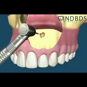 "Apicoectomy" explained in two minutes. watch video 👇👇👇 | Mind Dentistry