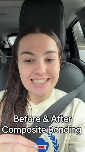Summer Dalton on Instagram: "I am SO happy with my results after my first appointment for composite bonding! I had it done on my top 4 teeth, and the 2 teeth on each side next to those we did a resin infiltration kit to disguise the white spots. I’m going back again to have more done so this isn’t the final result, but I LOVE it so far & have so much more confidence! With my wedding coming up in July this was on my to do list and honestly was under $1200!! And that includes 8 teeth, we only bond