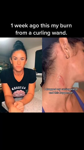 How to Treat a Curling Iron Burn: Tips and Remedies